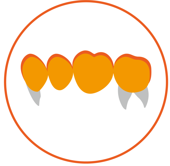 Reduced Posterior Bridge(â¥4 units)