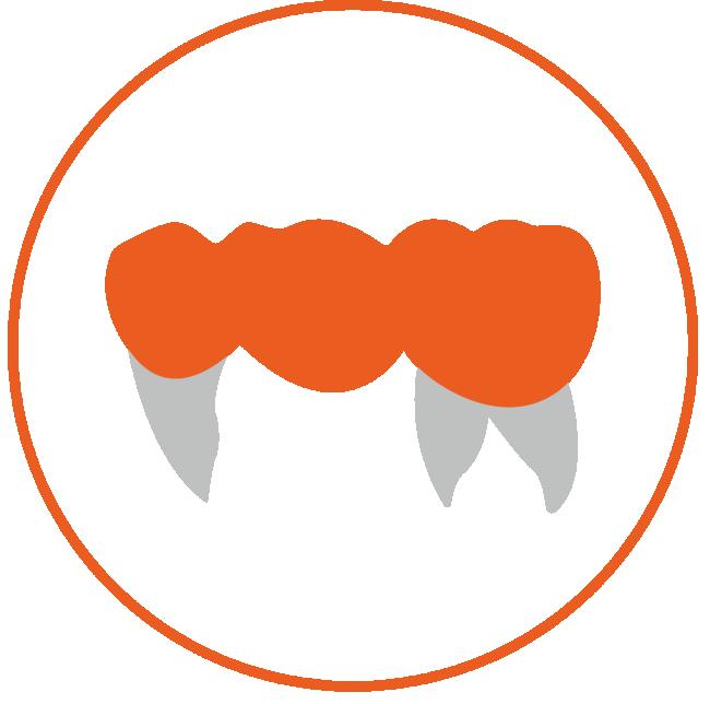 Posterior Bridge(3 units)