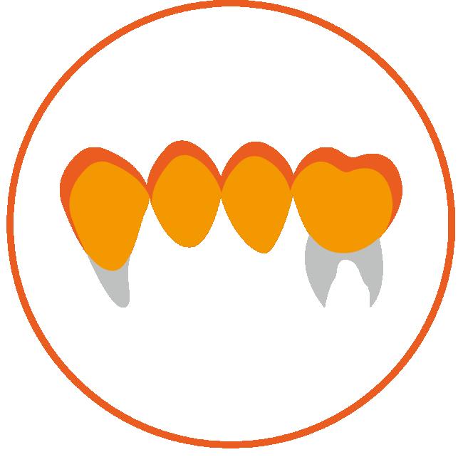 Reduced Posterior Bridge(4 units)