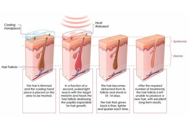 Laser precision