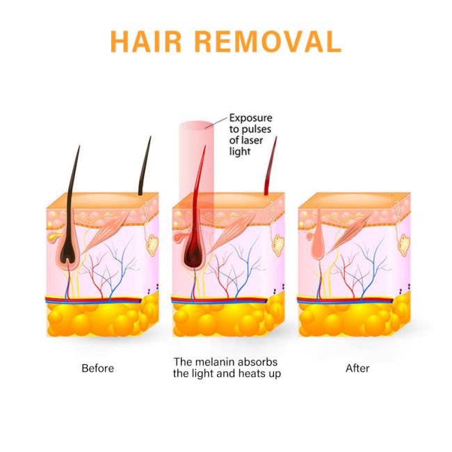 Professional laser machine hair removal depilation alexandrite 808 diode laser hair removal
