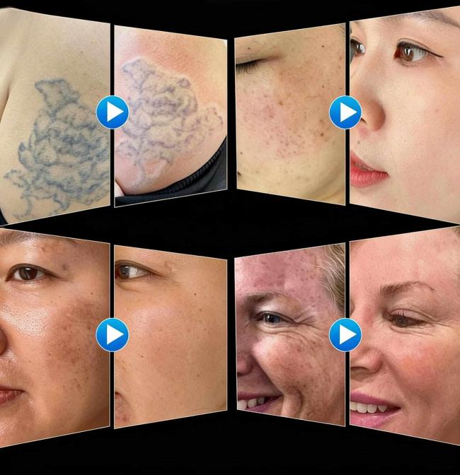 High Power Super Pico Laser Machine for Tattoo Removal, Melasma and Skin Rejuvenation 5