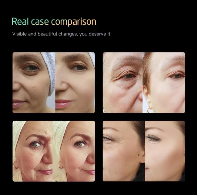 Professional HIFU RF EMS Skin Lifting and Body Sculpting Machine 8