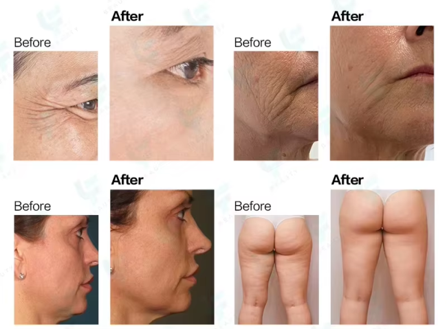 22D HIFU Machine for Face Lift & Body Contouring | Professional Skin Tightening Device 3