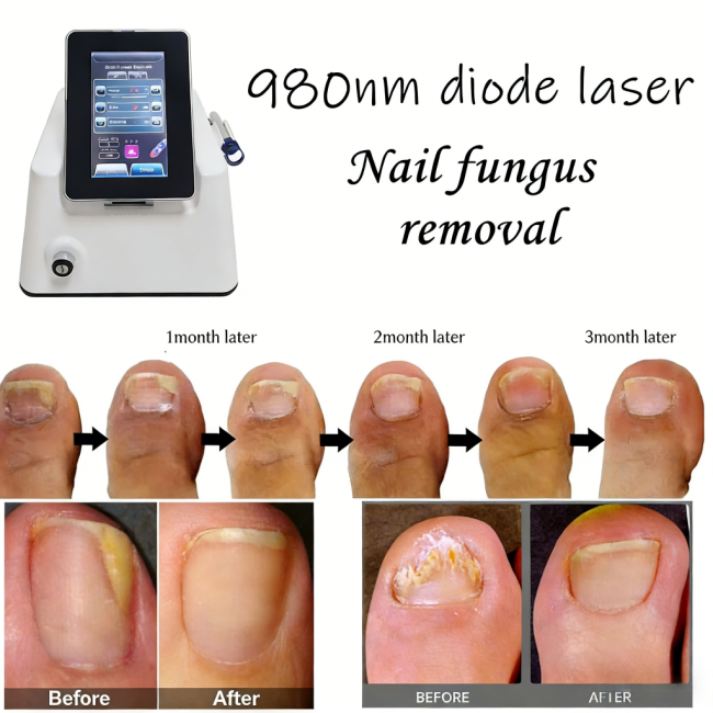 980nm Diode Laser Nail Fungus Treatment Machine with 30W Adjustable Power and 7 Inch Touch Screen for Professional Onychomycosis Therapy 0