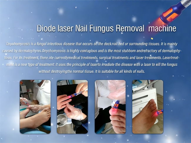 980nm Diode Laser Nail Fungus Treatment Machine with 30W Adjustable Power and 7 Inch Touch Screen for Professional Onychomycosis Therapy 2