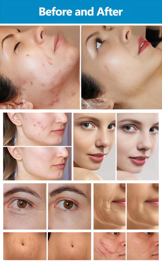 Professional 10.6 üm Wavelength COâââ¬Å¡Ã¢â¬Å¡ Laser Device with Multi-Applicator Treatment System and 7 Programmable Scanning Patterns 4