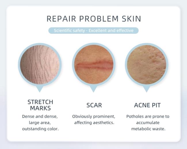 Advanced CO2 Laser System for Skin Rejuvenation, Lesion Removal & Vaginal Therapy 2