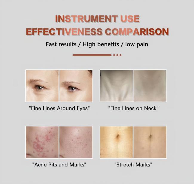 Non Surgical Facelift Machine RF Microneedling HIFU Skin Rejuvenation Device 3