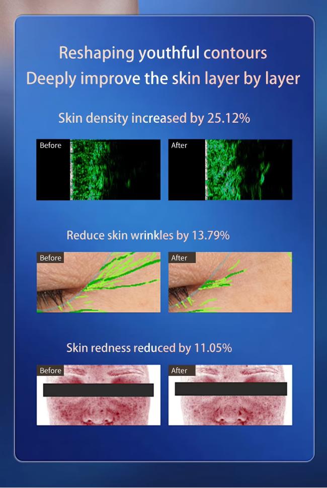 Non Surgical Facelift Machine RF Microneedling HIFU Skin Rejuvenation Device 4