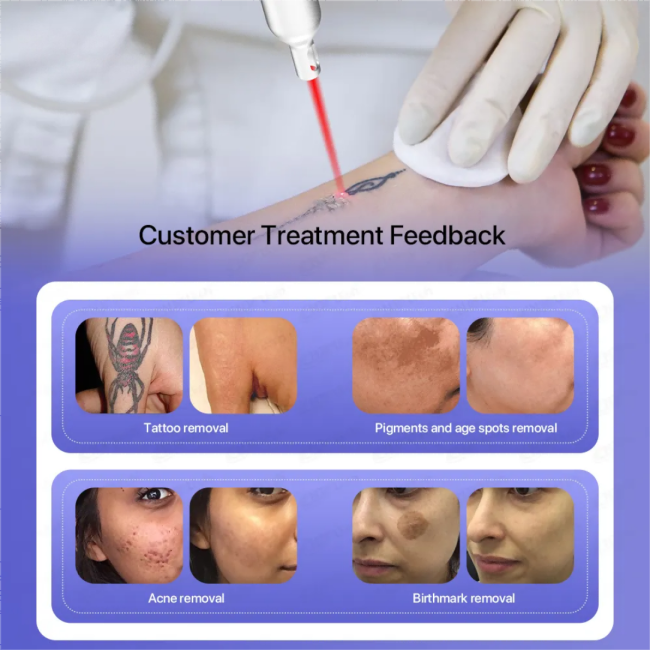 Advanced Pico Laser Machine for Beauty Salon Tattoo Removal & Pigmentation Treatment 3