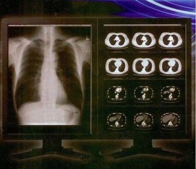 China Bright Clear Digital X Ray Film , Konida Medical Laser Transparency Film for sale
