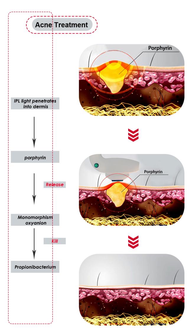 IPL acne machine