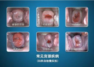 Китай Прибор высокого Colposcope цифров дисплея определения электронного портативный для того чтобы проверить Cervix и Vagin продается