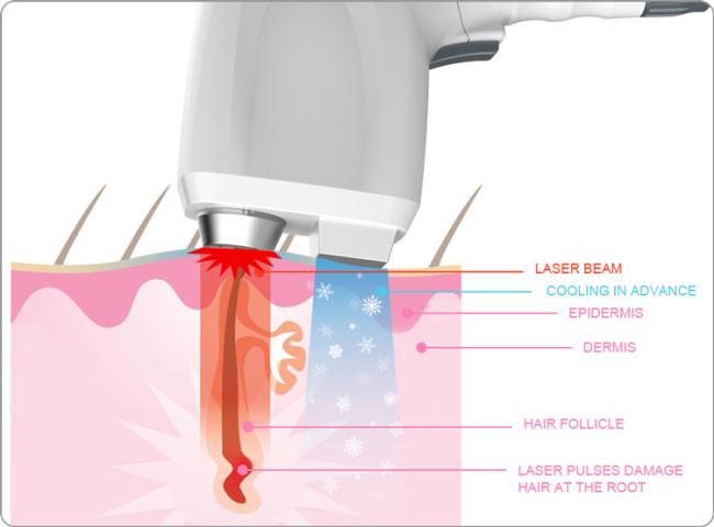 Top Quality Diode Laser 755nm+808nm+1064nm Diode Laser Hair Removal System