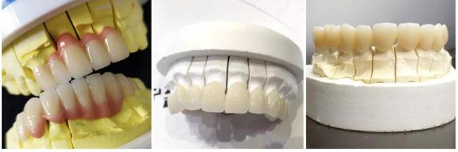 Dental restoration case study 2