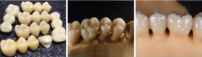 Dental restoration case study 1
