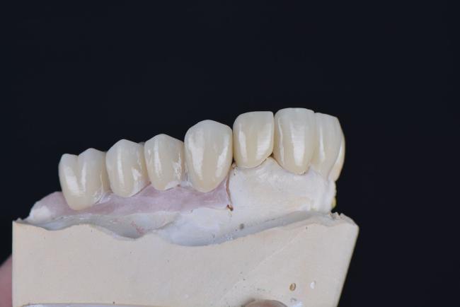 Dental zirconia block color variations