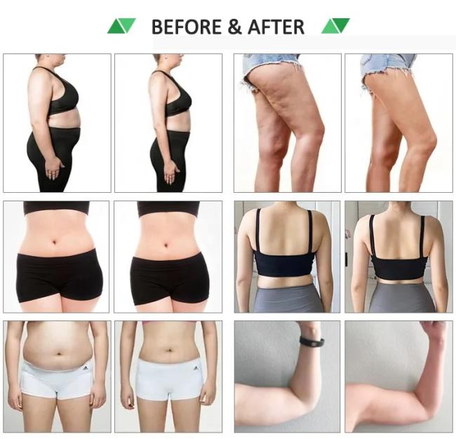 10d lipo laser before after
