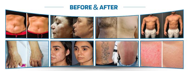 High Power ND:YAG Laser, Solid State Laser Device, Tattoo Removal Machine, Birthmark Removal Laser, Pigment Treatment Equipment, Carbon Peeling Laser System, Pore Shrinking Device, Eyebrow Cleaning Laser, Multi Wavelength Laser Machine, Adjustable Frequency Laser