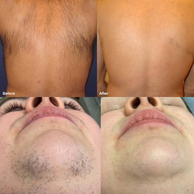 Portable Diode Laser Machine, 2 in 1 Hair Removal Device, Skin Analyzer Beauty Equipment, Triple Wavelength Laser System, Professional Hair Removal Machine, TEC Cooling Diode Laser, 808nm Diode Laser Device, Multi Wavelength Laser Hair Removal, Sapphire Contact Cooling Laser, Permanent Hair Removal Equipment
