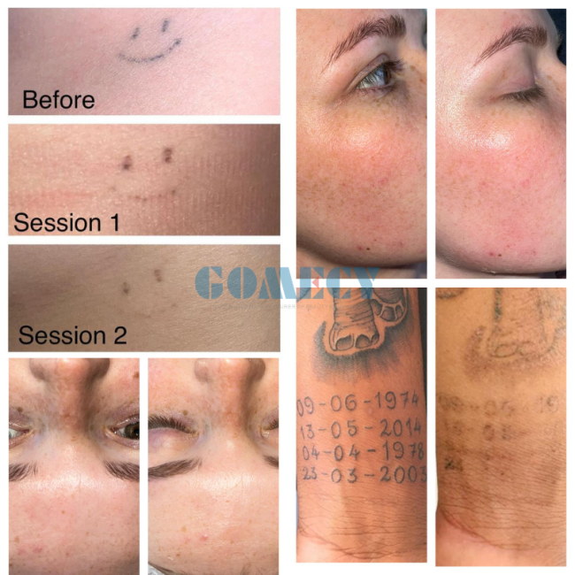 Advanced Q-Switched Nd YAG Laser System for Pigment Removal