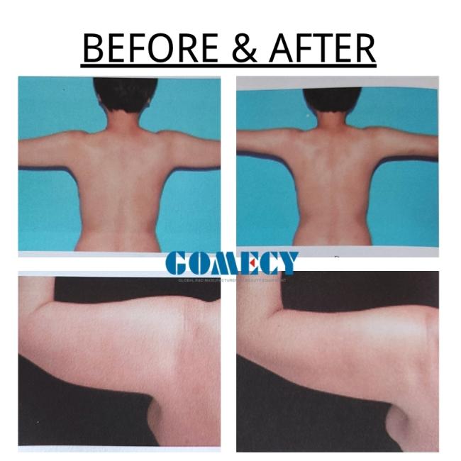 endolift results feedback