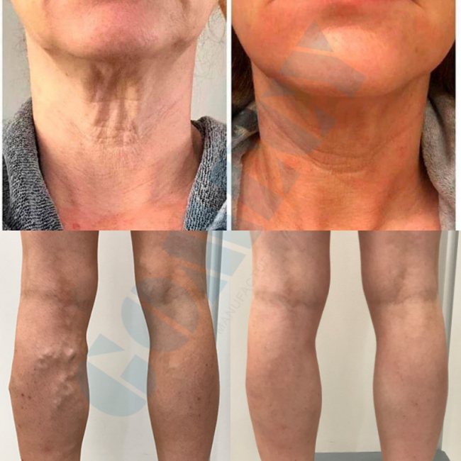 Triple Wavelength Diode Laser System for Vascular Removal Lipolysis Skin Rejuvenation