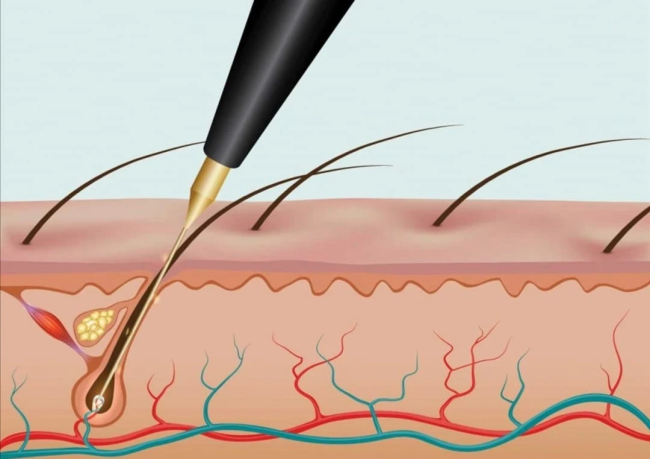 rf electrolysis hair removal machine
