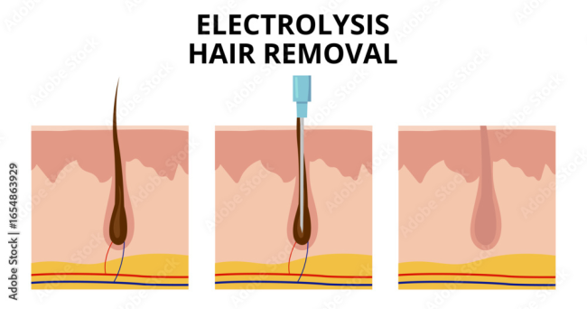 electrology hair removal electrolysis rf hair removal
