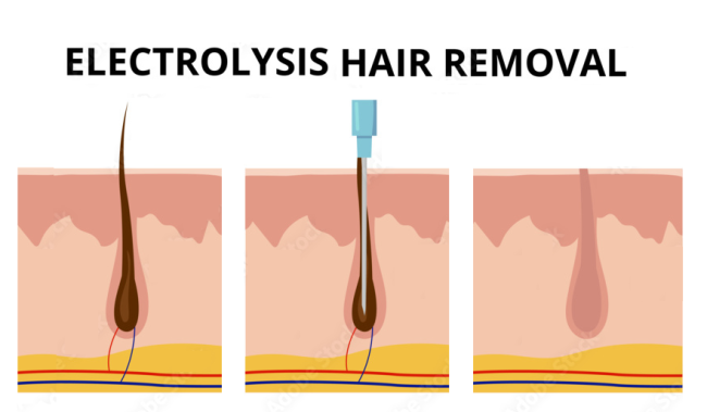 electrolysis hair remove veins removal skin beauty machne