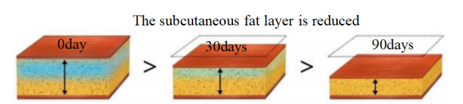 Fat reduction through cryolipolysis