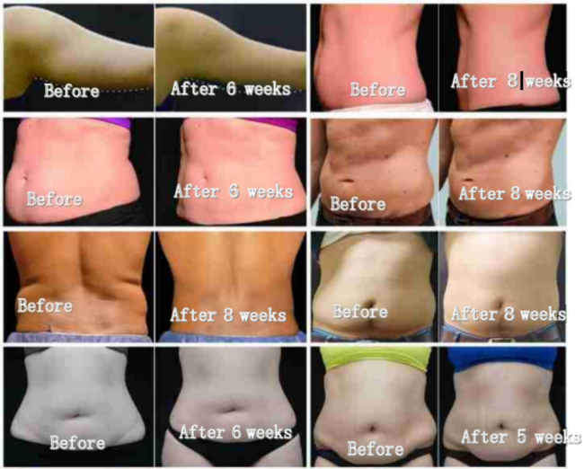 Body slimming weight loss by cryolipolysis HI EMT muscle stimulation