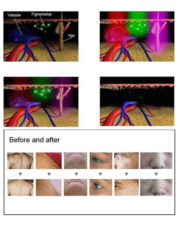 2021 trending product alibaba online shop hot seller stationary medical SHR IPL Laser Beauty Equipment