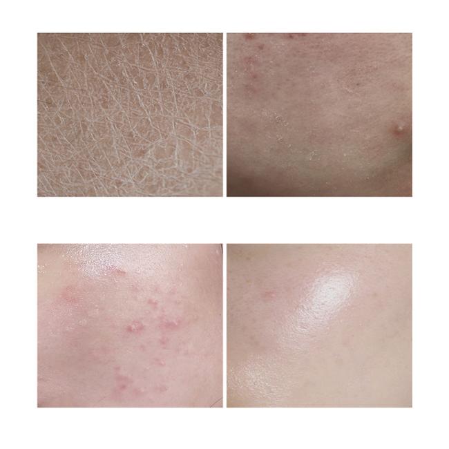 30ml Essence Face Serum 100% Pure Redness Radiant Skin Advanced Rosacea 1