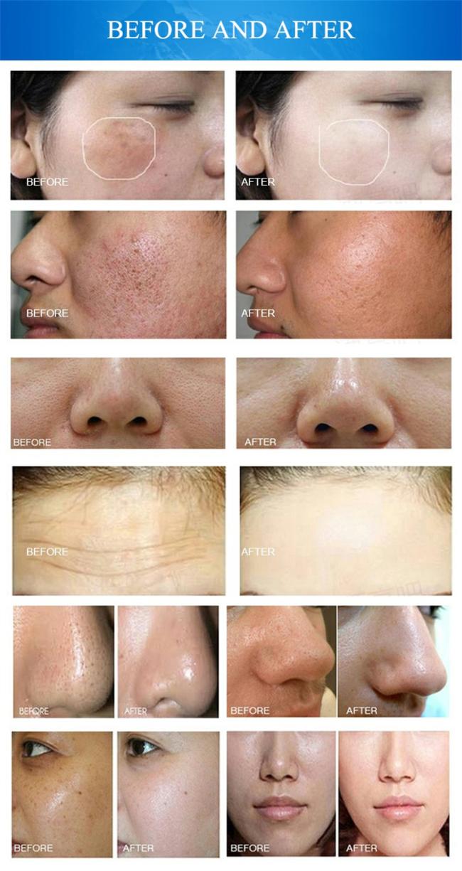 2023s Hot Sale 10-in-1 H2O2 Hydra Dermabrasion Deep Cleaning Oxygen Jet Microdermabrasion Aqua Peeling Beauty Machine