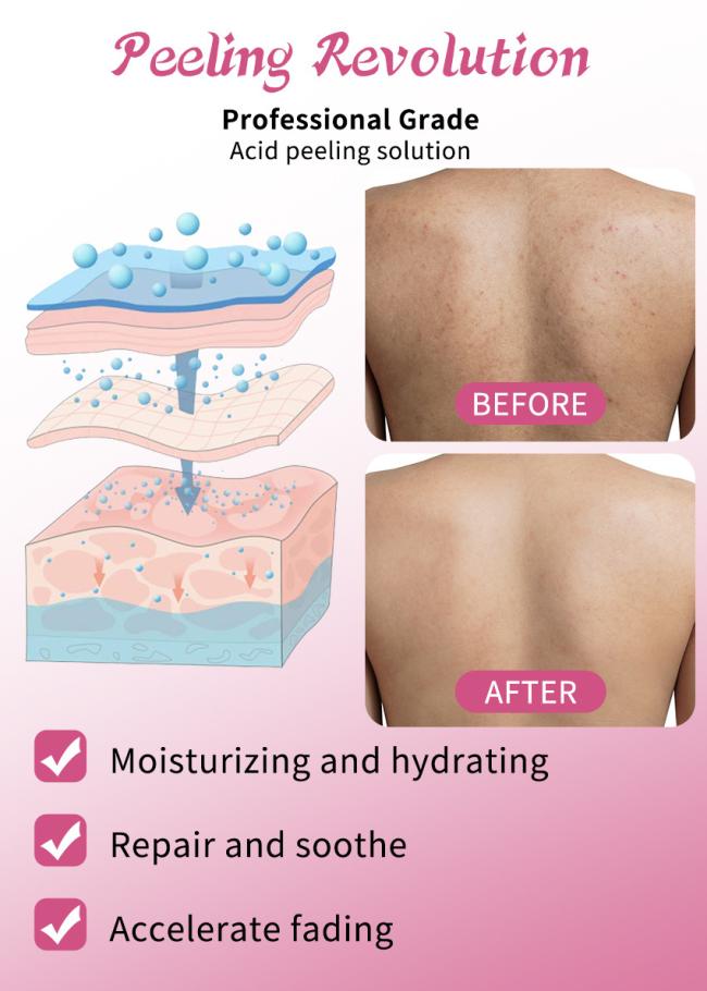 Skin Exfoliating Serum Oil Acid Peeling Solution Skin Peeling Serum