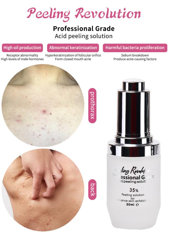 Skin Peeling Serum Remove Dead Skin Pigmentation Melasma Exfoliating Solution