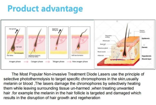 Fast and Efficient Diode Laser Hair Removal Machine for Men and Women 1