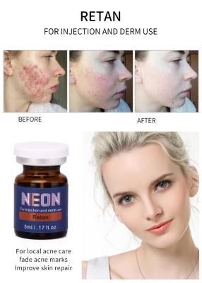 China Essência pura do soro meso de néon do tratamento da acne da injeção 5ml do soro da terapia à venda