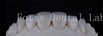 China Smooth Polished Ceramic Laminate Veneers In Dentistry Smile Creators for sale