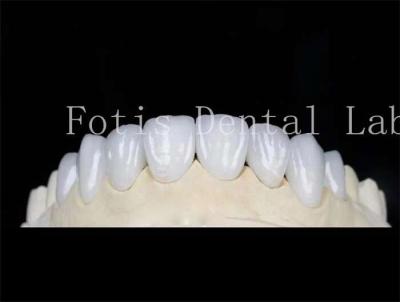 Chine Veneurs dentaires laminés de couleur naturelle Faux veneurs dentaires avec ciment de liaison à vendre