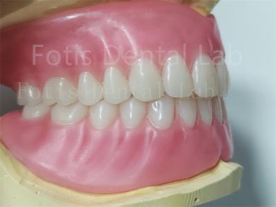 China Ivoclar Teeth Full Acrylic Denture Prosthesis Easy To Clean High Durability for sale