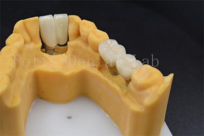 China Customizable Dental Restoration Implant Crown Replacement Various Sizes for sale