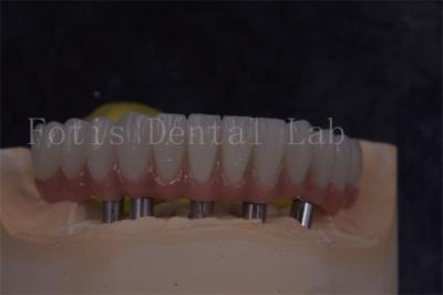 Chine Des couronnes d'implants dentaires personnalisables pour une apparence naturelle et des restaurations confortables à vendre