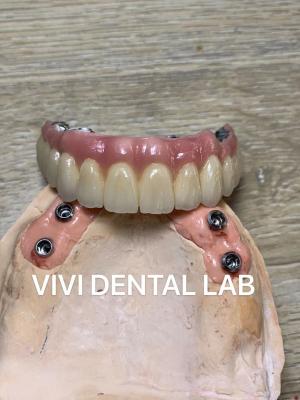 China Implante Dental Livre de Níquel Berílio Coroa Estética Ponte Completa de Implantes à venda