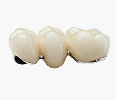 China Semi Precious Alloy Crowns PFM Restorations VIVI Dental Laboraotry for sale