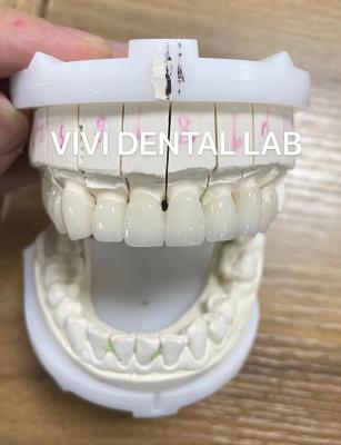 China Alta estética Coroas de laboratorio dentales de zirconia Puente con porcelana en capas en venta