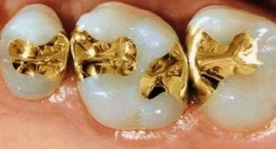 Chine Incrustations dentaires douces couronnes encrustées en or 74% à vendre