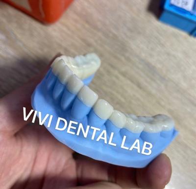 China Designed Milled Dental Snap On Teeth For Increasing Vertical Bite for sale